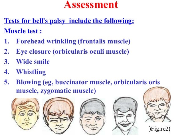 facial palsy definition Sex in the holocaust